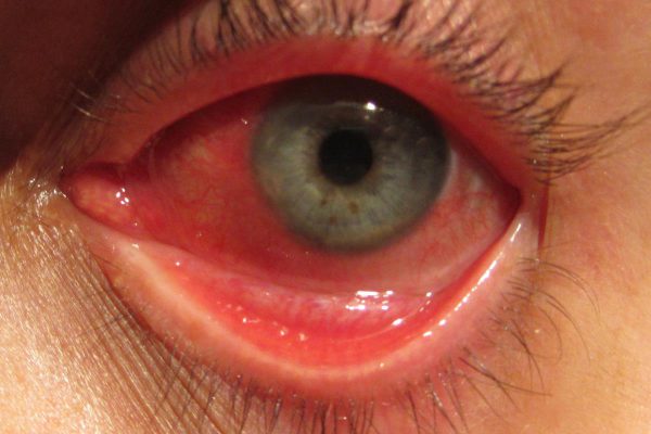 Bệnh viêm màng bồ đào (hay còn gọi là Uveitis) gây viêm bên trong mắt khiến mắt trở nên sưng đỏ. Viêm màng bồ đào có thể lây lan và gây tổn thương mắt rất nhanh chính vì vậy những người mắc bệnh này cần được chăm sóc và điều trị kịp thời. Bệnh thường chiếm đến khoảng 5.5% bệnh liên quan đến các bệnh về mắt.